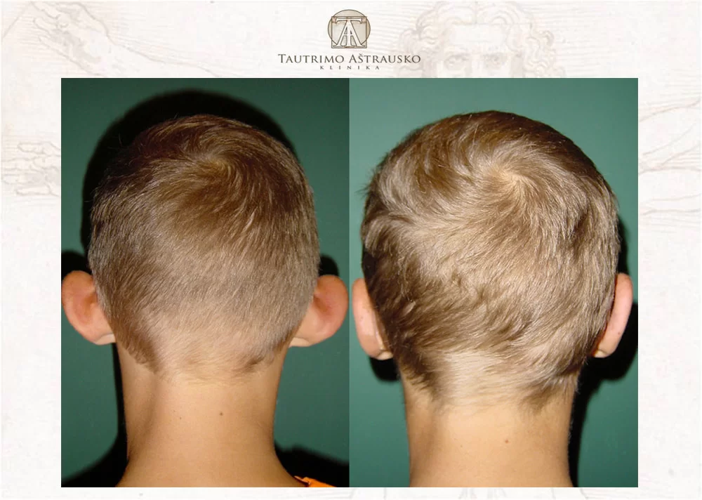 Ausų plastinė operacija